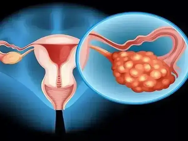 卵巢囊肿做试管婴儿成功率多少(图1)