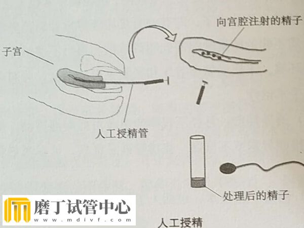 做三代试管有哪些痛苦(图3) 做三代试管有哪些痛苦(图3)