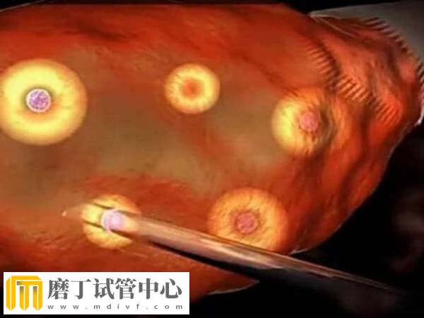 做三代试管有哪些痛苦(图4) 做三代试管有哪些痛苦(图4)